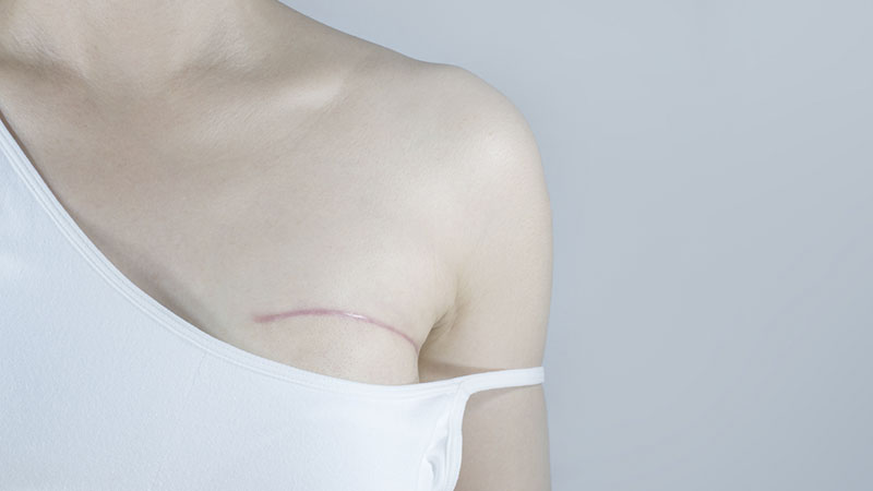 Cicatriz devido a retirada da mama