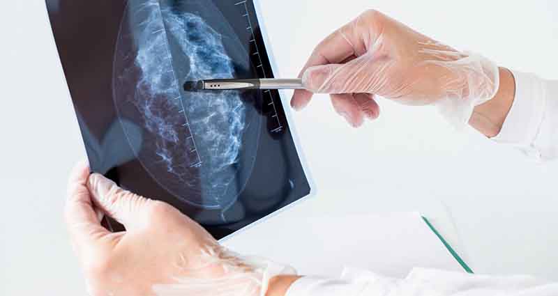 exame de mamografia analisando o tratamento